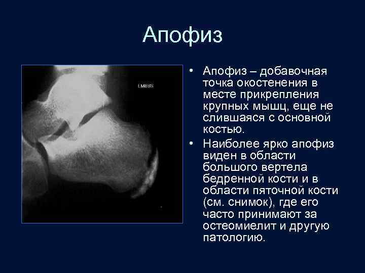 Апофиз • Апофиз – добавочная точка окостенения в месте прикрепления крупных мышц, еще не