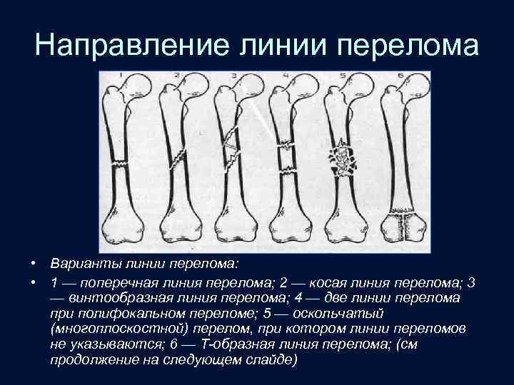Направление линии перелома • Варианты линии перелома: • 1 — поперечная линия перелома; 2