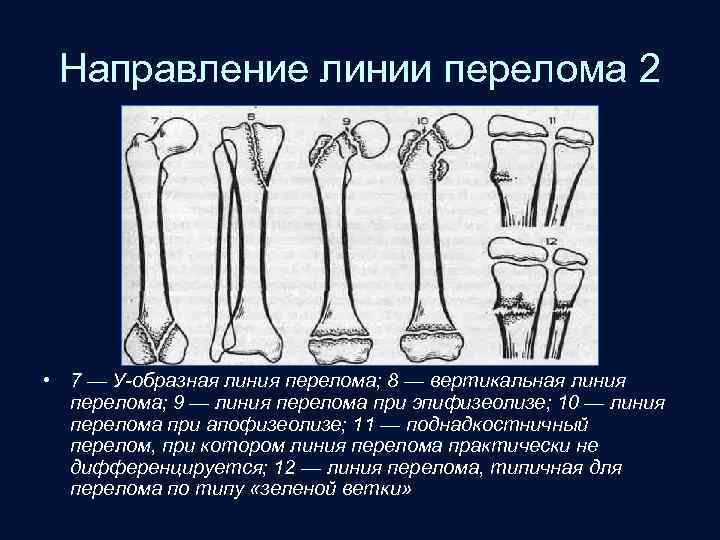Направление линии перелома 2 • 7 — У-образная линия перелома; 8 — вертикальная линия