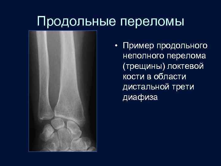 Продольные переломы • Пример продольного неполного перелома (трещины) локтевой кости в области дистальной трети