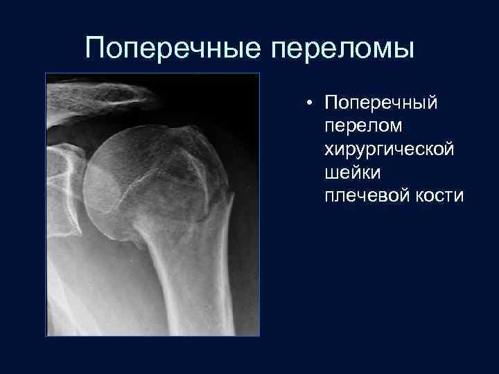 Поперечные переломы • Поперечный перелом хирургической шейки плечевой кости 