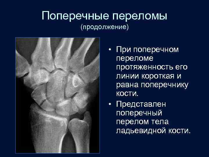 Поперечные переломы (продолжение) • При поперечном переломе протяженность его линии короткая и равна поперечнику