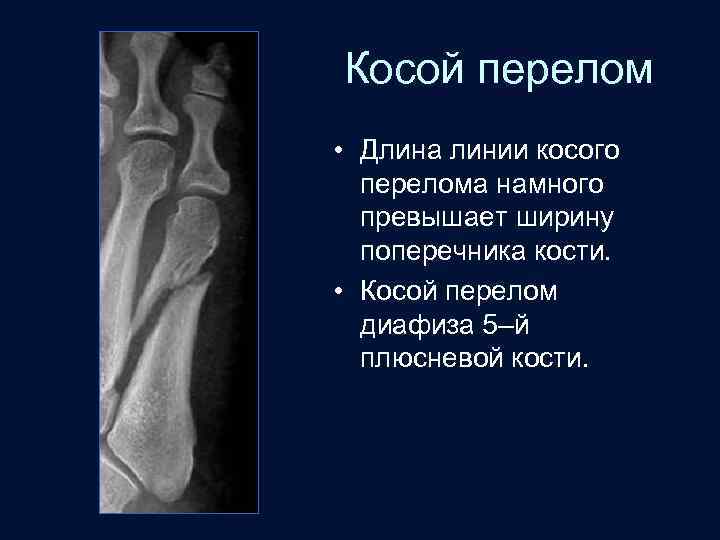 Косой перелом • Длина линии косого перелома намного превышает ширину поперечника кости. • Косой
