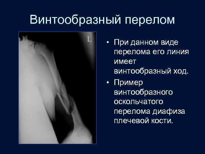 Винтообразный перелом • При данном виде перелома его линия имеет винтообразный ход. • Пример