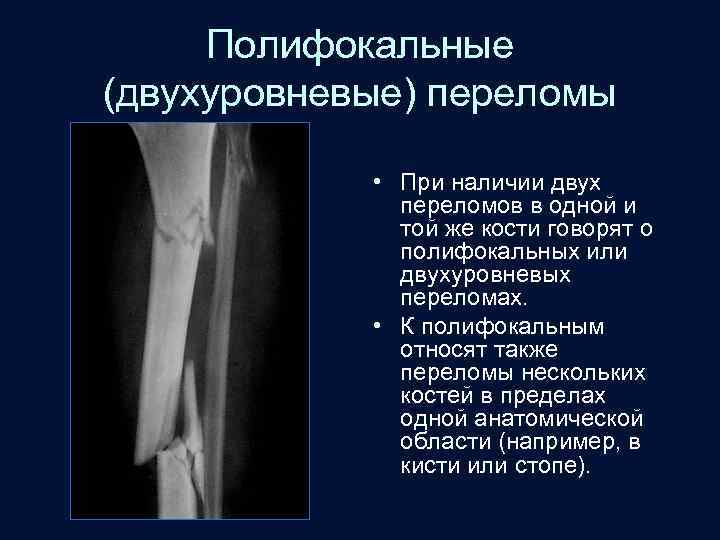 Полифокальные (двухуровневые) переломы • При наличии двух переломов в одной и той же кости