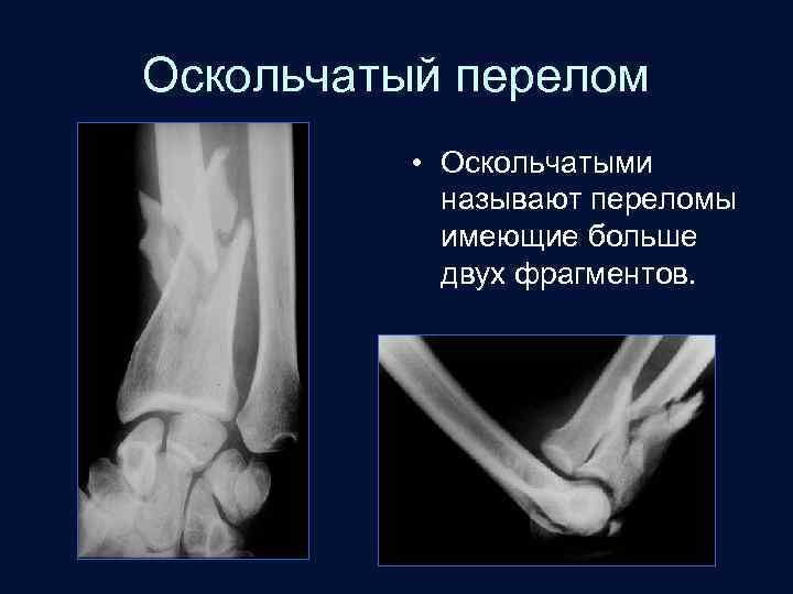 Оскольчатый перелом • Оскольчатыми называют переломы имеющие больше двух фрагментов. 