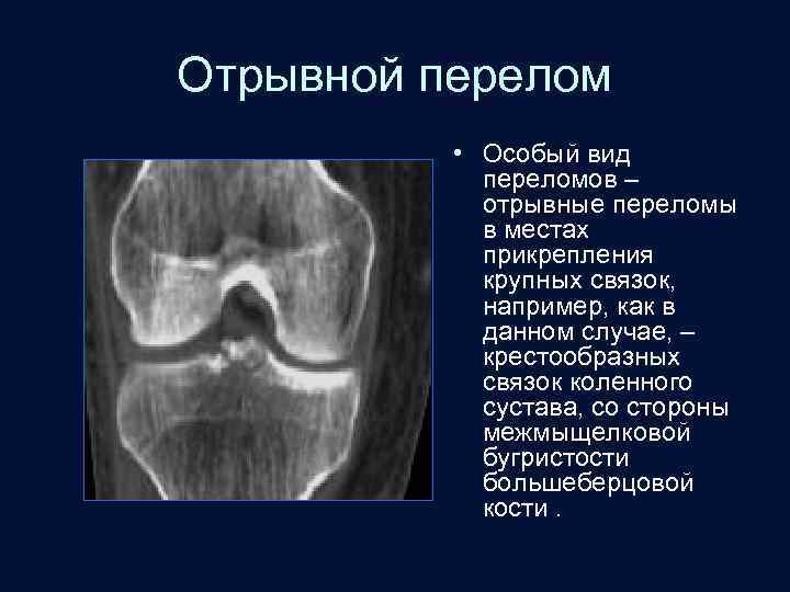 Отрывной перелом • Особый вид переломов – отрывные переломы в местах прикрепления крупных связок,