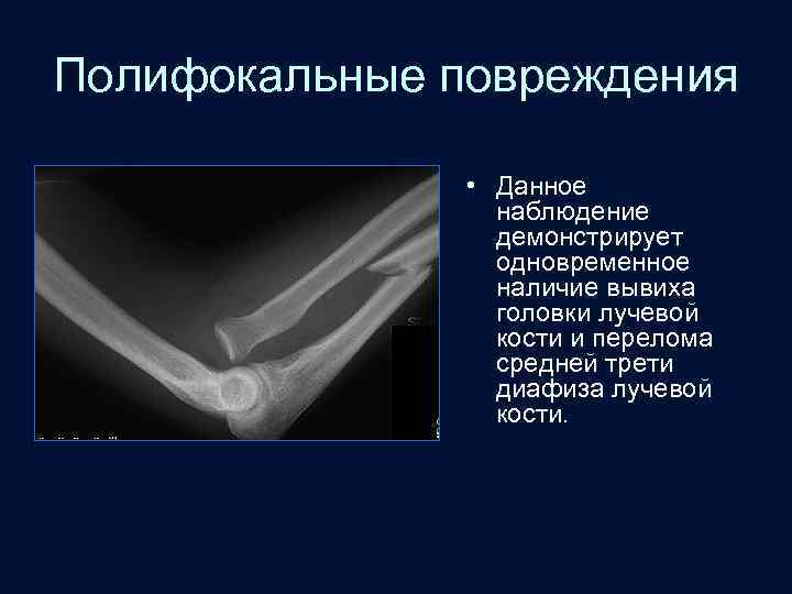 Полифокальные повреждения • Данное наблюдение демонстрирует одновременное наличие вывиха головки лучевой кости и перелома