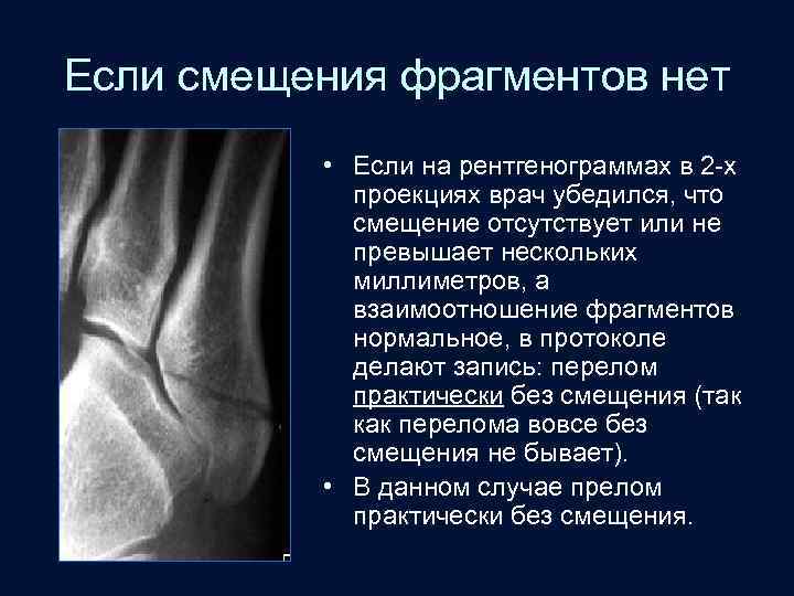 Если смещения фрагментов нет • Если на рентгенограммах в 2 -х проекциях врач убедился,