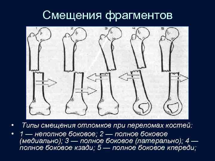Смещения фрагментов • Типы смещения отломков при переломах костей: • 1 — неполное боковое;