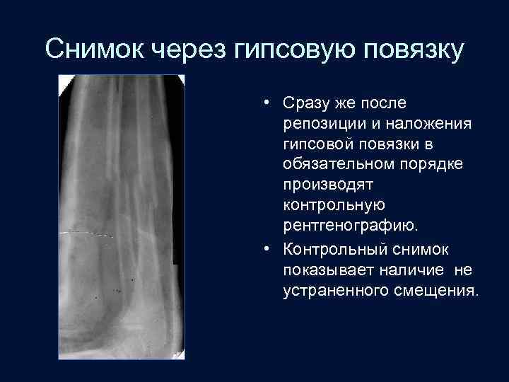 Снимок через гипсовую повязку • Сразу же после репозиции и наложения гипсовой повязки в