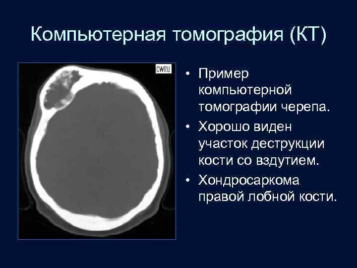 Компьютерная томография (КТ) • Пример компьютерной томографии черепа. • Хорошо виден участок деструкции кости