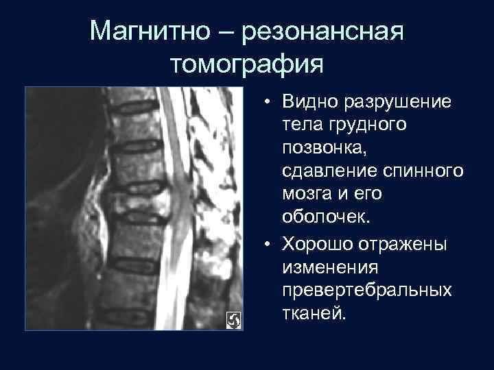 Магнитно – резонансная томография • Видно разрушение тела грудного позвонка, сдавление спинного мозга и