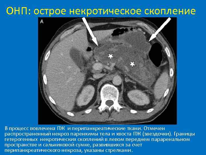 ОНП: острое некротическое скопление В процесс вовлечена ПЖ и перипанкреатические ткани. Отмечен распространенный некроз