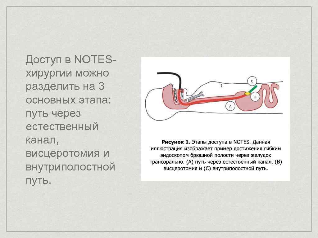 Транслюминальная хирургия презентация