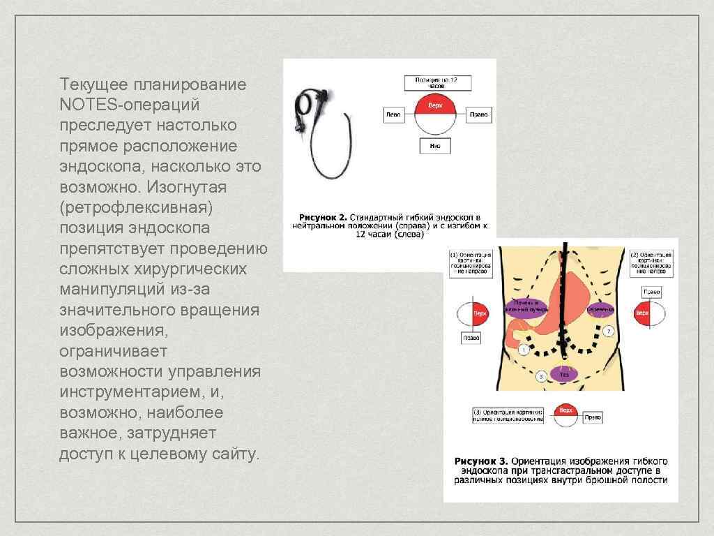 Транслюминальная хирургия презентация