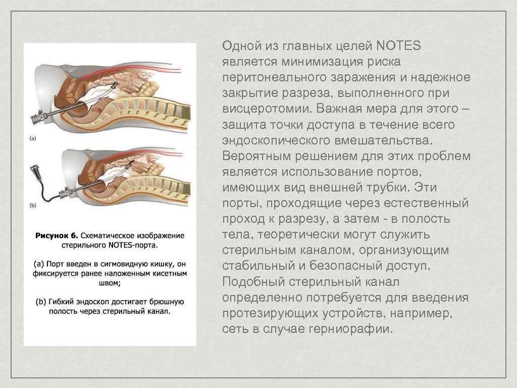 Одной из главных целей NOTES является минимизация риска перитонеального заражения и надежное закрытие разреза,