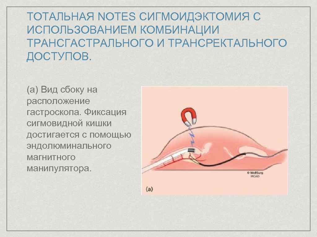 ТОТАЛЬНАЯ NOTES СИГМОИДЭКТОМИЯ С ИСПОЛЬЗОВАНИЕМ КОМБИНАЦИИ ТРАНСГАСТРАЛЬНОГО И ТРАНСРЕКТАЛЬНОГО ДОСТУПОВ. (а) Вид сбоку на