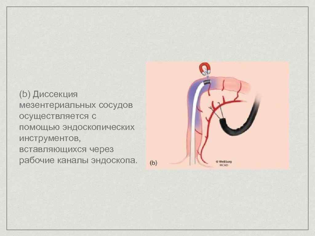 (b) Диссекция мезентериальных сосудов осуществляется с помощью эндоскопических инструментов, вставляющихся через рабочие каналы эндоскопа.