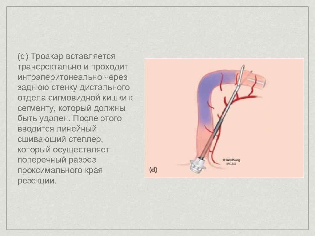 (d) Троакар вставляется трансректально и проходит интраперитонеально через заднюю стенку дистального отдела сигмовидной кишки