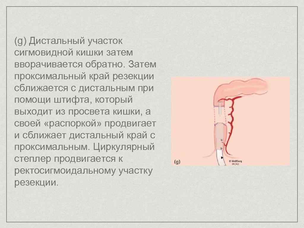 (g) Дистальный участок сигмовидной кишки затем вворачивается обратно. Затем проксимальный край резекции сближается с