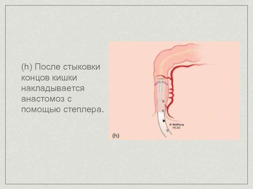 Транслюминальная хирургия презентация