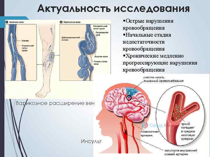 Актуальность исследования §Острые нарушения кровообращения §Начальные стадия недостаточности кровообращения §Хронические медленно прогрессирующие нарушения кровообращения