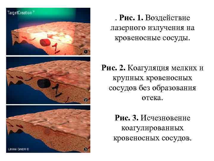 . Рис. 1. Воздействие лазерного излучения на кровеносные сосуды. Рис. 2. Коагуляция мелких и
