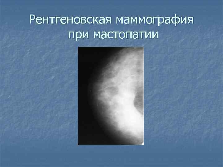 Рентгеновская маммография при мастопатии 