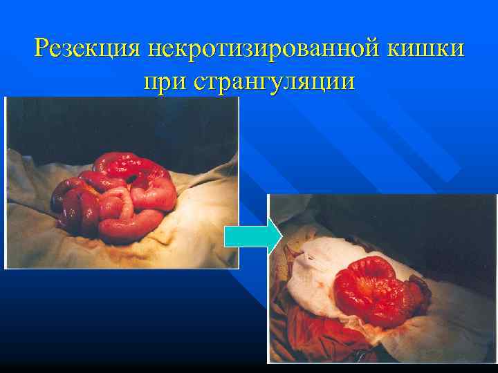 Резекция некротизированной кишки при странгуляции 