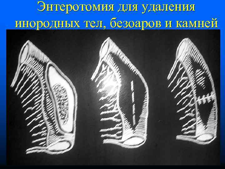 Энтеротомия для удаления инородных тел, безоаров и камней 