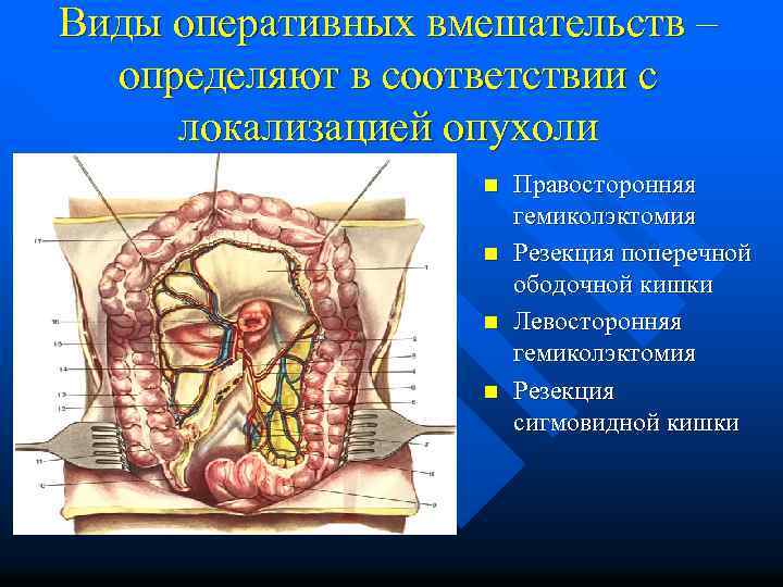 Виды оперативных вмешательств – определяют в соответствии с локализацией опухоли n n Правосторонняя гемиколэктомия