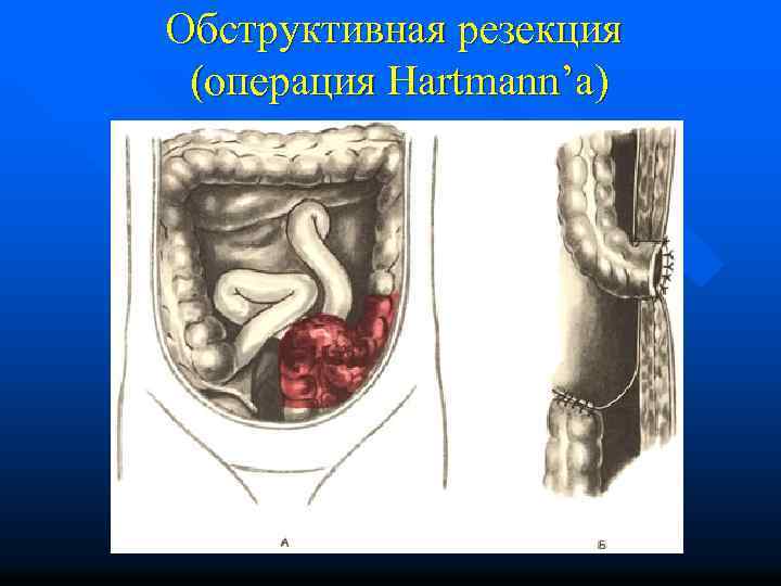 Обструктивная резекция (операция Hartmann’а) 