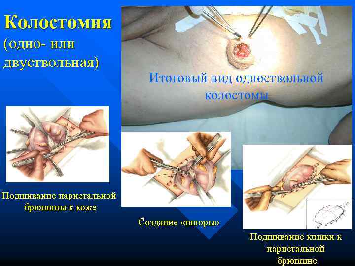 Колостомия (одно- или двуствольная) Итоговый вид одноствольной колостомы Подшивание париетальной брюшины к коже Создание