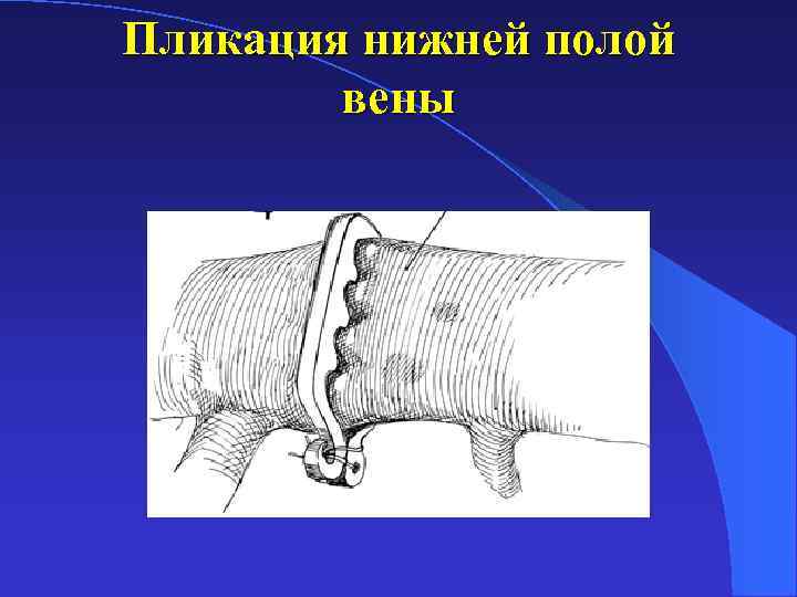 Нижней полой. Пликация нижней полой вены операция. Клипирование нижней полой вены это.