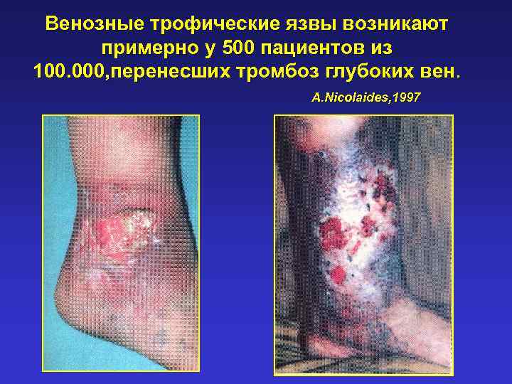 Венозные трофические язвы возникают примерно у 500 пациентов из 100. 000, перенесших тромбоз глубоких