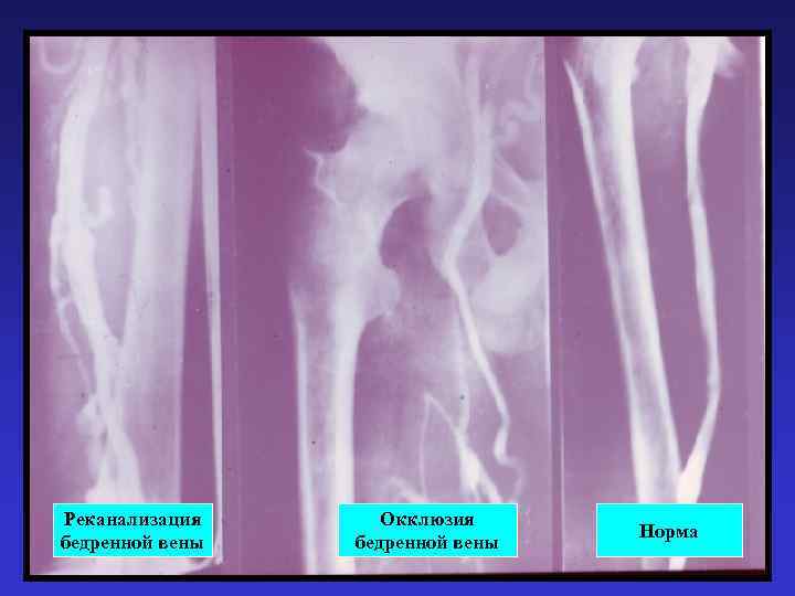 Норма вены. Реканализация тромба нижних конечностей что это. Реканализированный тромбоз что это. Реканализация тромба в Вене нижней конечности. Реканализация сосудов нижних конечностей.