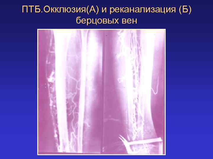 Тромбоз глубоких вен нижних конечностей карта вызова скорой медицинской помощи шпаргалка скорой