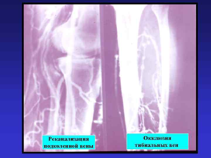 Тромбоз подколенной вены фото