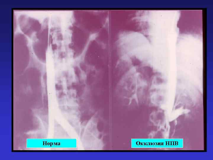 Норма Окклюзия НПВ 