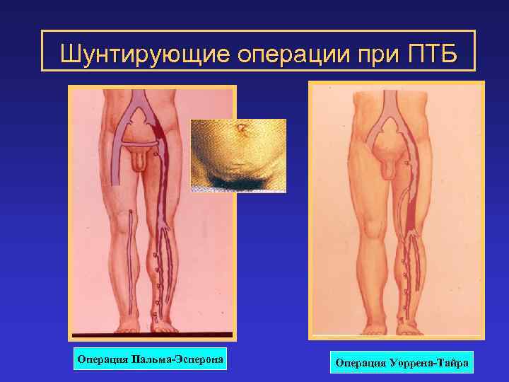 Шунтирующие операции при ПТБ Операция Пальма-Эсперона Операция Уоррена-Тайра 