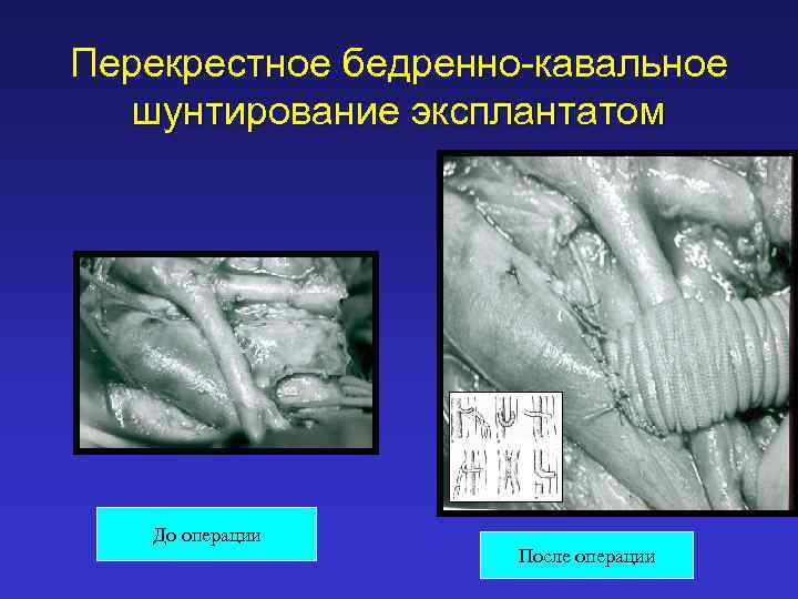 Перекрестное бедренно-кавальное шунтирование эксплантатом До операции После операции 