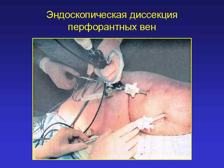 Эндоскопическая диссекция перфорантных вен 