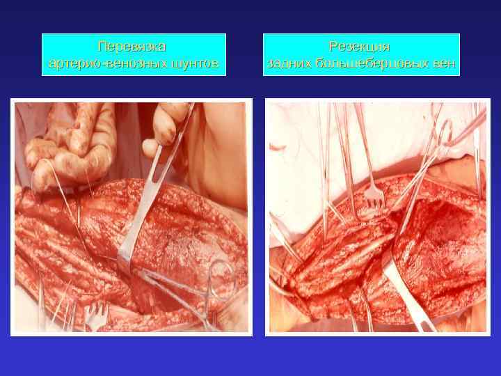 Перевязка артерио-венозных шунтов Резекция задних большеберцовых вен 
