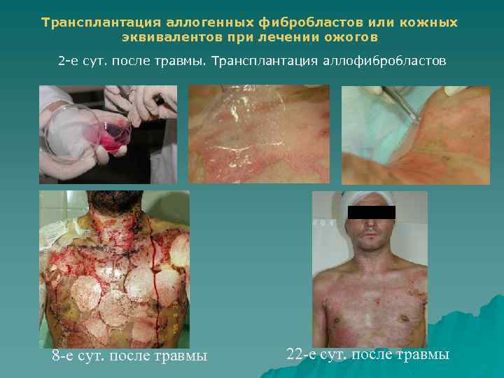 Трансплантация аллогенных фибробластов или кожных эквивалентов при лечении ожогов 2 -е сут. после травмы.