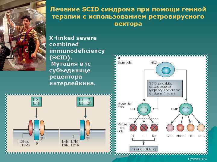 Лечение SCID синдрома при помощи генной терапии с использованием ретровирусного вектора X-linked severe combined