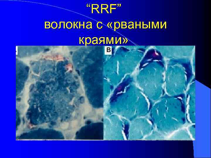 Митохондриальные заболевания презентация