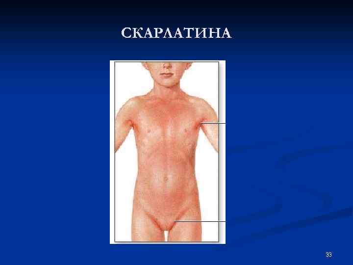 СКАРЛАТИНА 33 