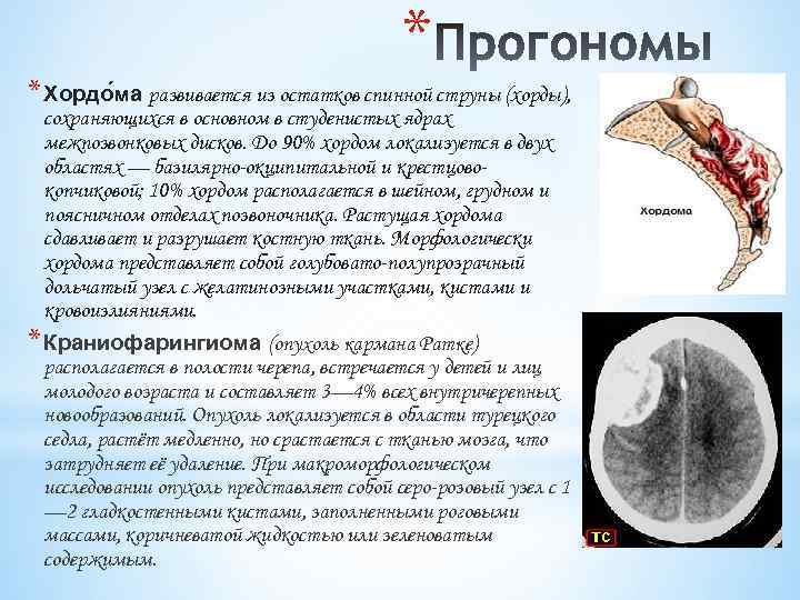 * * Хордо ма развивается из остатков спинной струны (хорды), сохраняющихся в основном в