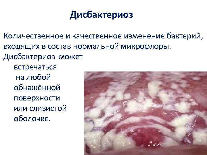 Дисбактериоз Количественное и качественное изменение бактерий, входящих в состав нормальной микрофлоры. Дисбактериоз может встречаться